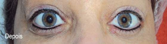 Micropigmentação de Olhos em Guarulhos