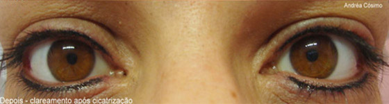 Micropigmentação de Olhos em Guarulhos